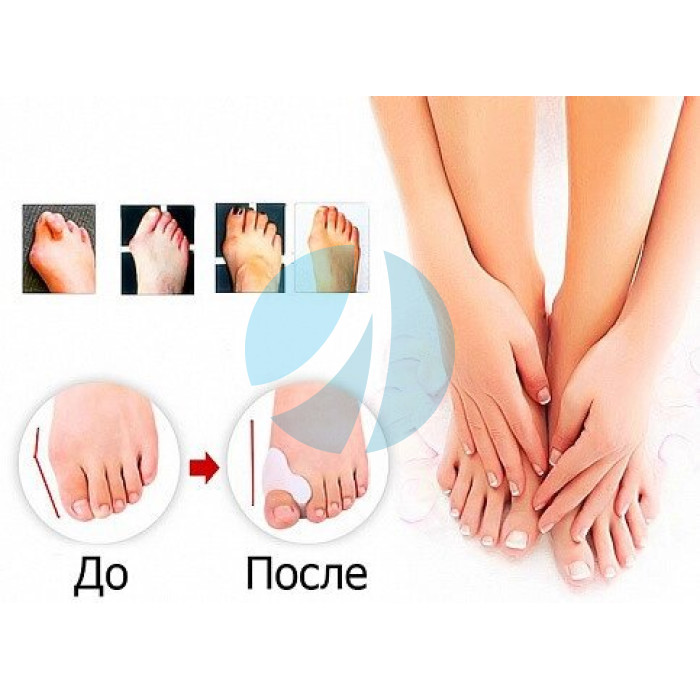 Фіксатор для корекції кісточки великого пальця ноги valgus pro Фіксатор для корекції кісточки великого пальця ноги valgus pro